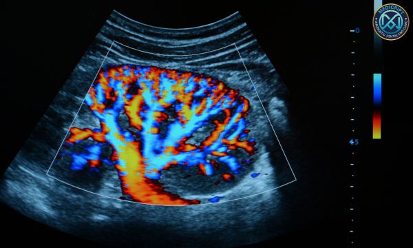 Color Doppler Ultrasound