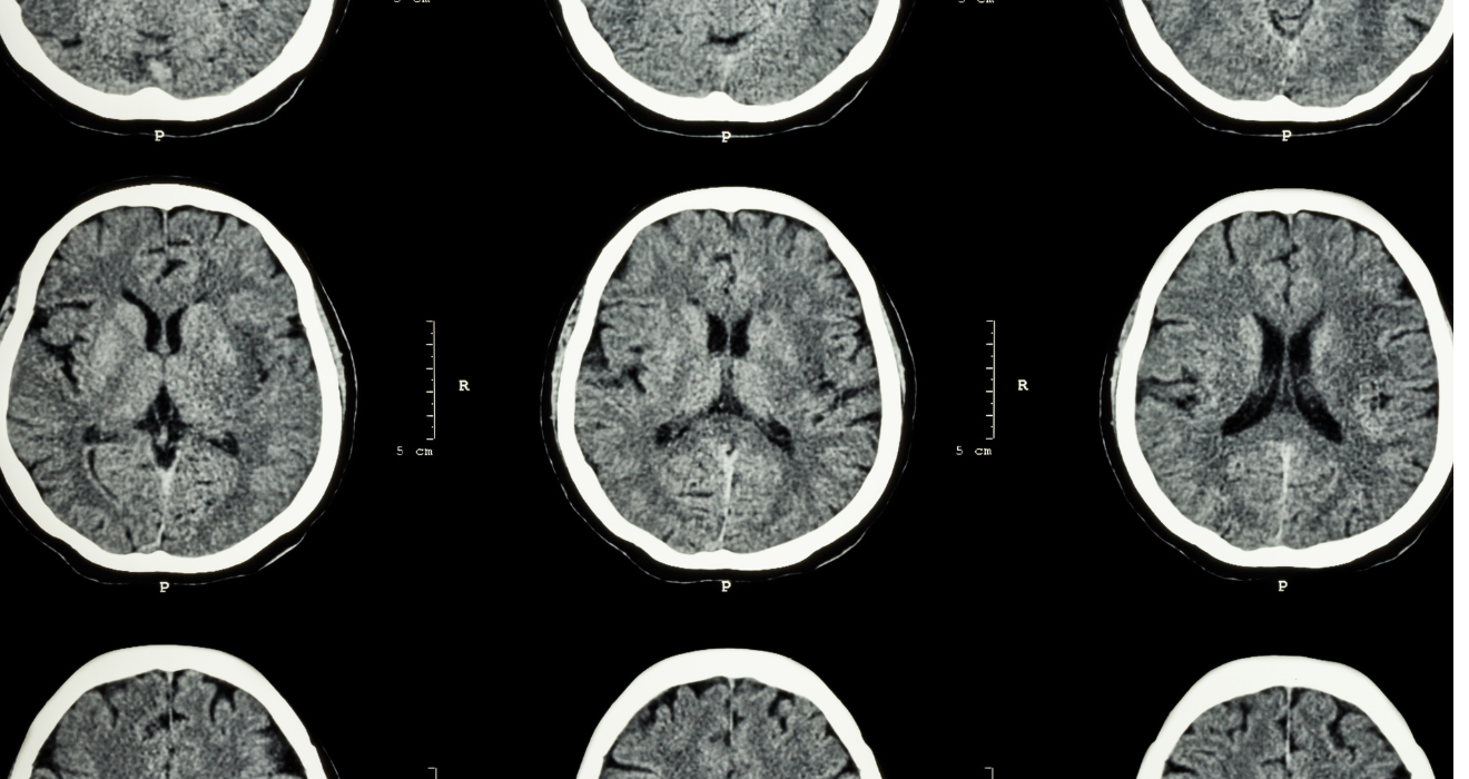 CT SCan