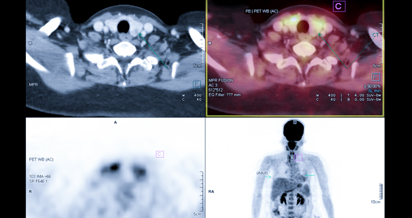 CT SCan